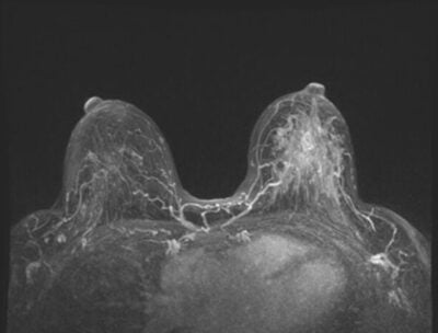 Breast MRI