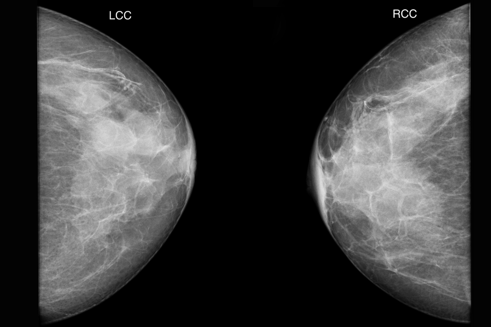 dense breasts